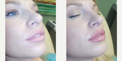 Juvederm before and after photo
