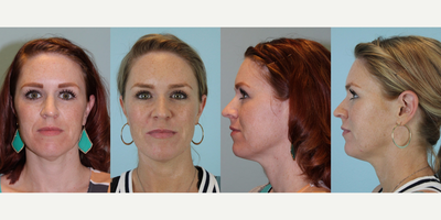 Juvederm before and after photo