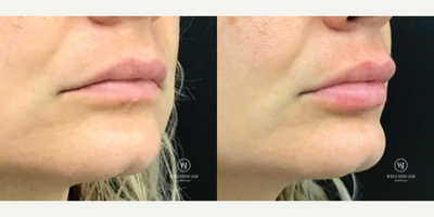 Lip Fillers before and after photo