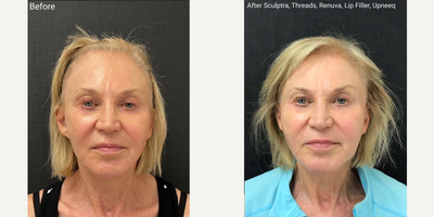 Sculptra before and after photo