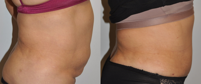 Tummy Tuck before and after photo