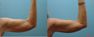 Arm Lift before and after photo