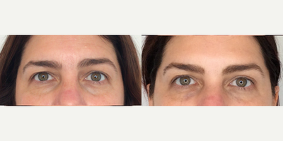 Botox before and after photo