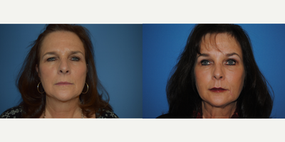 Brow Lift before and after photo