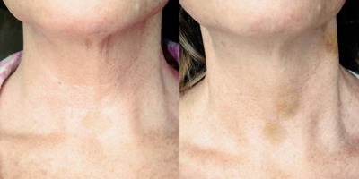 Radiesse before and after photo