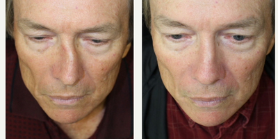 Rhinoplasty before and after photo