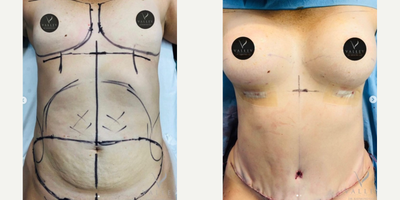 Breast Augmentation before and after photo