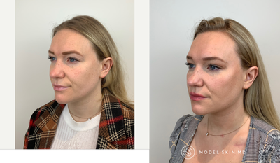 Dermal Fillers before and after photo