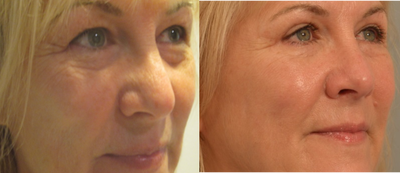 Eyelid Surgery before and after photo