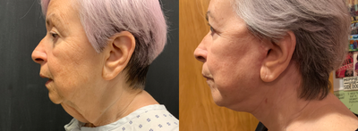 Facelift before and after photo