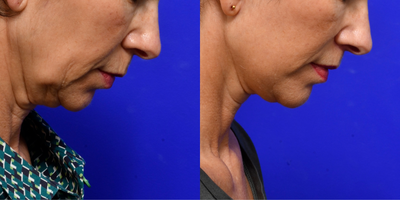 Facelift before and after photo