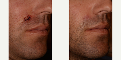 Mohs Surgery before and after photo