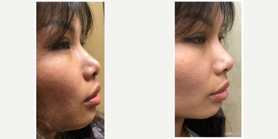 Voluma before and after photo