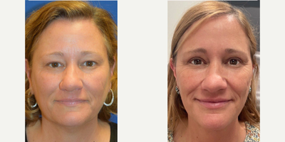 Eyelid Surgery before and after photo