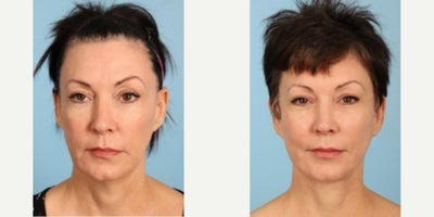 Facelift before and after photo