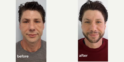 Fractional Laser before and after photo