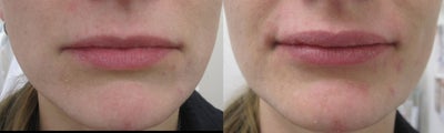 Juvederm before and after photo