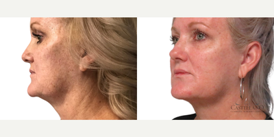 NovaThreads before and after photo