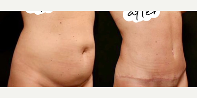 Tummy Tuck before and after photo
