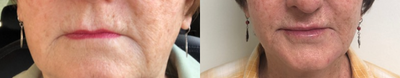 Voluma before and after photo