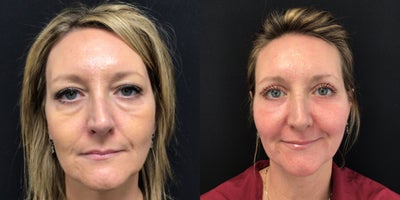 Eyelid Surgery before and after photo