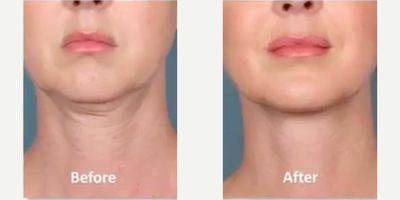 Kybella before and after photo