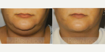 Liposuction before and after photo