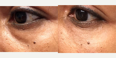 Restylane before and after photo