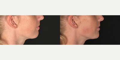 Chin Filler before and after photo