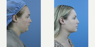 Chin Liposuction before and after photo