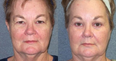 Eyelid Surgery before and after photo