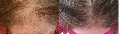 PRP for Hair Loss before and after photo