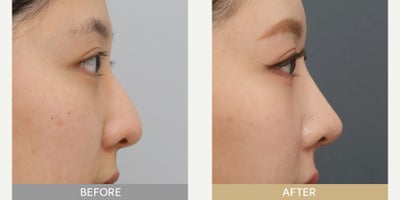 Rhinoplasty before and after photo