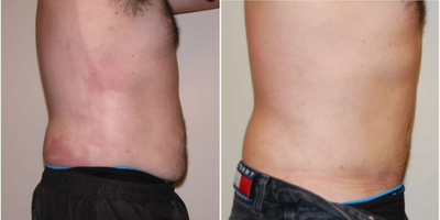Tummy Tuck before and after photo