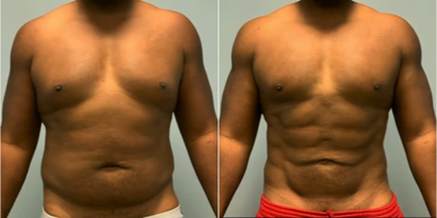 Abdominal Etching before and after photo