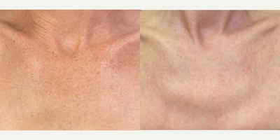 Fractional Laser before and after photo