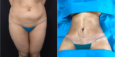 Body Lift before and after photo