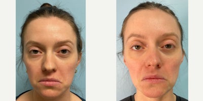 before and after image