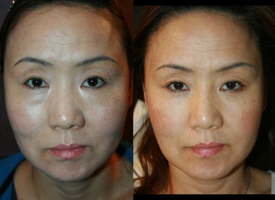 Facelift before and after photo