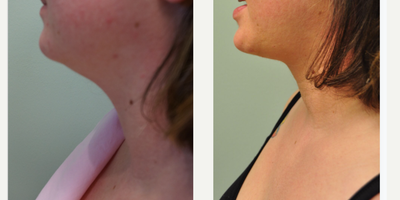 Liposuction before and after photo