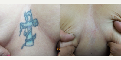 PicoSure before and after photo