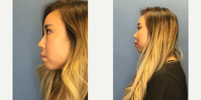 Restylane before and after photo