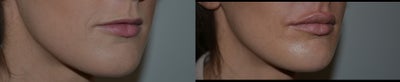 Botox before and after photo