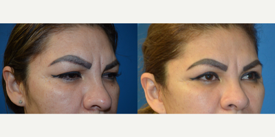 Eyelid Surgery before and after photo