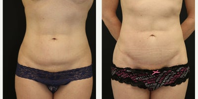 Mini Tummy Tuck before and after photo
