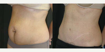 Tummy Tuck before and after photo