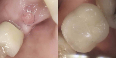 Dental Implants before and after photo