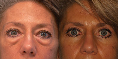Eyelid Surgery before and after photo