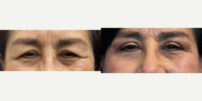 Eyelid Surgery before and after photo