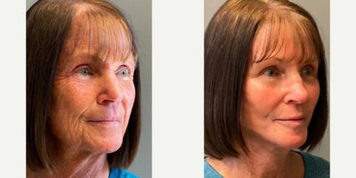 Facelift before and after photo